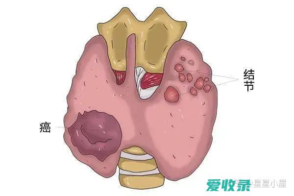 体检结节是怎么回事 一图看懂什么是结节、息肉、囊肿、增生